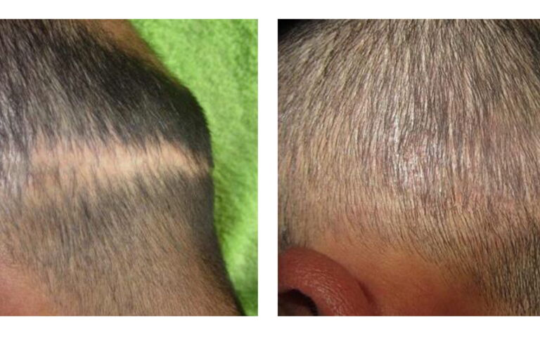 Kopfhautpigmentation Narbenkaschierung: vorher / nachher