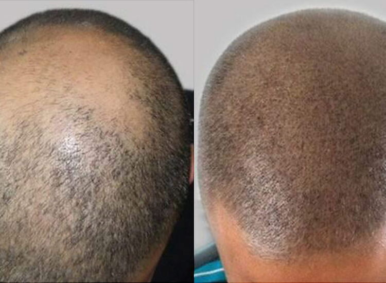 Kosmetikpraxis Saphir: Kopfhautpigmentation in Luzern