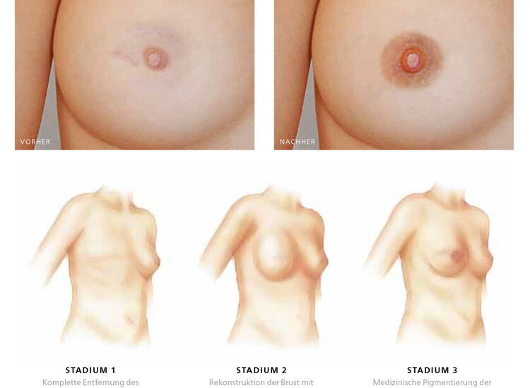 Areola Brustwarzenpigmentation Luzern - vorher und nachher